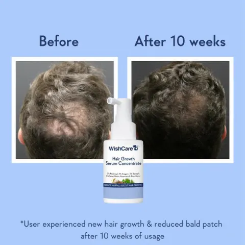 Top of a man's head before and after hair growth serum, showing reduced bald spot.