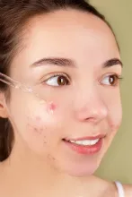 Young woman applying serum to acne-prone skin with a glass dropper.
