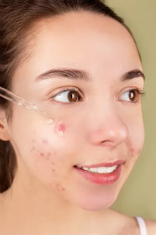 Young woman applying serum to acne-prone skin with a glass dropper.