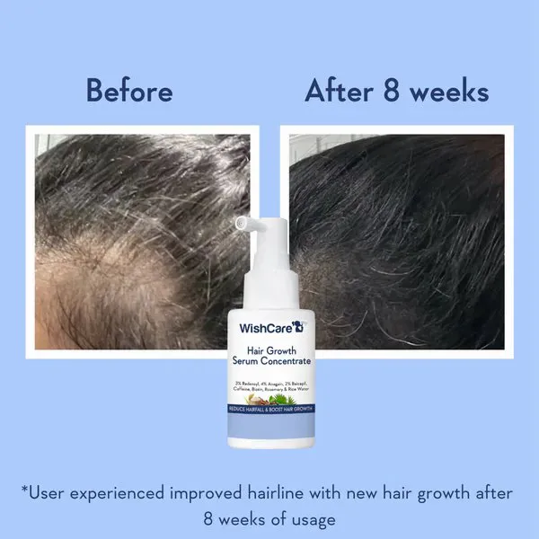 Comparison of scalp before and after hair growth serum use, with product bottle centered below.